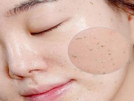 Sản phẩm tẩy tế bào chết cho da mụn tốt nhất hiện nay