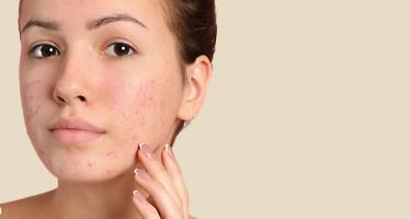 Kem trị mụn giá bình dân và hiệu quả nhất có thể bạn muốn biết