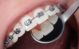 Địa chỉ niềng răng uy tín nhất quận Đống Đa, Hà Nội