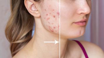 Spa trị mụn hiệu quả nhất quận Đống Đa, Hà Nội