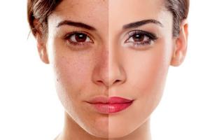 Spa trị nám tốt nhất Long An