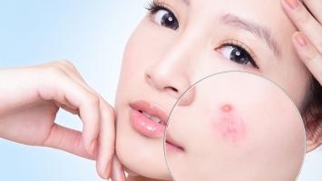 Spa trị mụn hiệu quả nhất TX. Quảng Yên, Quảng Ninh