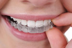 Địa chỉ niềng răng uy tín nhất quận Hoàn Kiếm, Hà Nội