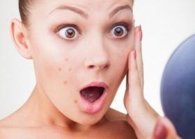 Bí quyết chăm sóc da mụn hiệu quả nhất