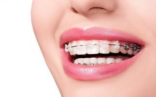 Địa chỉ niềng răng trả góp uy tín nhất Hà Nội