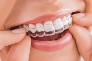 Địa chỉ niềng răng Invisalign uy tín, chất lượng nhất tại TP. Thủ Đức