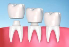 Địa chỉ bọc răng sứ uy tín nhất tỉnh Kon Tum