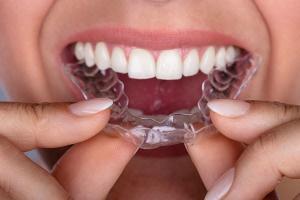 Địa chỉ niềng răng invisalign uy tín nhất tại Hà Nội