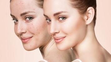 Loại kem trị mụn trứng cá tốt nhất