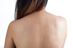 Xà phòng trị mụn tốt nhất hiện nay
