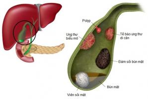 Lưu ý quan trọng nhất về bệnh polyp túi mật