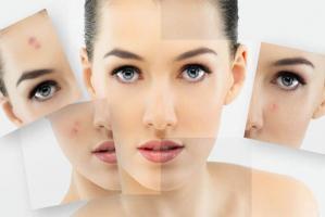 Spa trị mụn hiệu quả nhất tỉnh Thanh Hóa