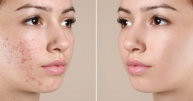 Thanh lăn trị mụn tốt nhất hiện nay