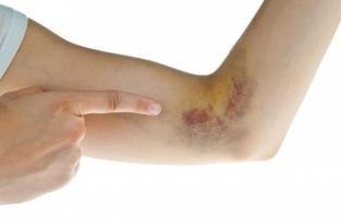 Biện pháp trị vết bầm tím hiệu quả