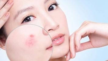 Cách ngăn ngừa mụn hiệu quả nhất một cách tự nhiên