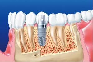 Lưu ý quan trọng nhất khi trồng răng implant