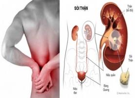Công thức thần kì đánh bay sỏi thận không lo tái phát