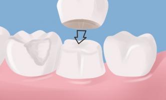 Địa chỉ bọc răng sứ thẩm mỹ tốt nhất tại quận 2, TP. HCM