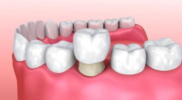 Nha khoa bọc răng sứ thẩm mỹ tốt nhất tại quận Ba Đình, Hà Nội
