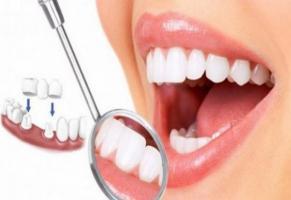 Địa chỉ bọc răng sứ thẩm mỹ tốt nhất tại quận Hai Bà Trưng, Hà Nội