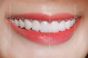 Địa chỉ bọc răng sứ uy tín nhất Bến Tre