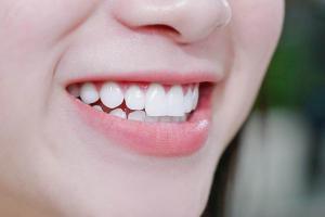 Địa chỉ bọc răng sứ uy tín nhất tỉnh Bình Định