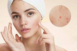 Spa chăm sóc da và điều trị da mụn uy tín nhất tại Hà Nội