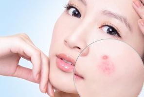 Địa chỉ chữa mụn trứng cá tốt nhất tại Hà Nội