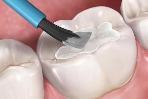 Địa chỉ hàn răng hiệu quả tốt nhất tại Hà Nội