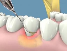 Địa chỉ lấy cao răng an toàn và uy tín nhất tại Hà Nội