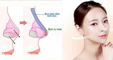 Địa chỉ nâng mũi đẹp và an toàn nhất tỉnh Khánh Hòa
