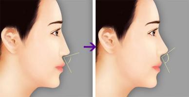 Địa chỉ nâng mũi đẹp và an toàn nhất tỉnh Kon Tum