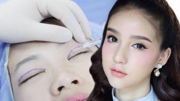 Địa chỉ cắt mí, nhấn mí đẹp và an toàn nhất TP. Buôn Ma Thuột, Đắk Lắk