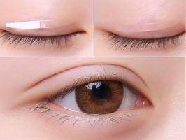 Địa chỉ nhấn mí đẹp và an toàn nhất TP. Hạ Long, Quảng Ninh