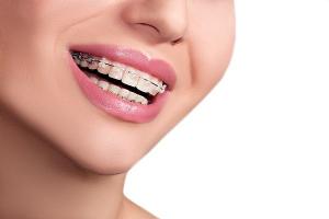 Địa chỉ niềng răng uy tín nhất quận 7, TP. HCM