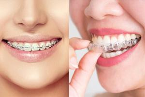 Địa chỉ niềng răng uy tín nhất tỉnh Quảng Trị