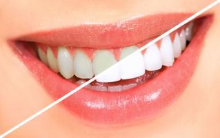 Địa chỉ tẩy trắng răng uy tín nhất tỉnh Lâm Đồng