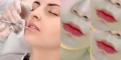 Địa chỉ tiêm môi đẹp và chất lượng nhất Cần Thơ