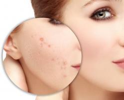 Địa chỉ trị thâm uy tín nhất tỉnh Khánh Hòa
