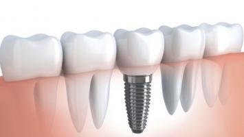 Nha khoa trồng răng Implant tốt nhất tại Hà Nội