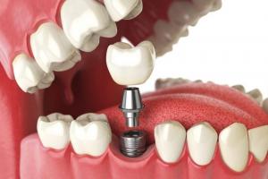Địa chỉ trồng răng implant uy tín nhất Hải Dương