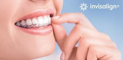 Điều cần biết khi niềng răng trong suốt invisalign
