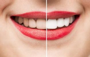 Điều cần biết khi tẩy trắng răng