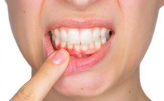 Điều nên làm khi chảy máu chân răng