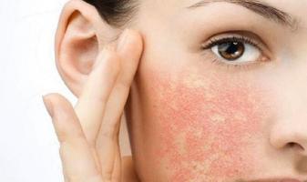 Điều cần biết về dị ứng mỹ phẩm