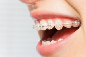 Điều cần biết về niềng răng mắc cài sứ dây trong