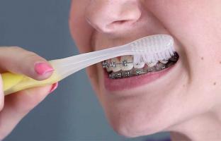 Kem đánh răng cho người niềng răng, chỉnh nha tốt nhất hiện nay