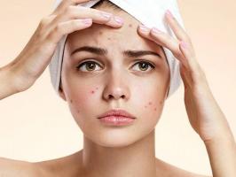 Kem trị mụn cho da dầu, làm giảm thâm mụn hiệu quả nhất hiện nay