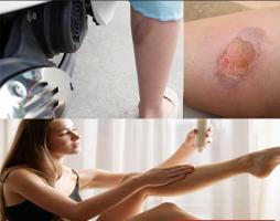 Kem trị sẹo bỏng bô tốt nhất trên thị trường hiện nay