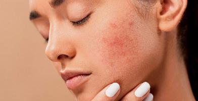 Loại kem trị mụn ẩn dưới da tốt nhất
